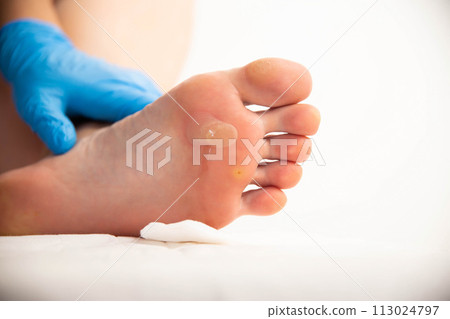 A doctor examines the foot of a person who has a large callus and a stem wart. Treatment and removal of warts and corns, close-up 113024797