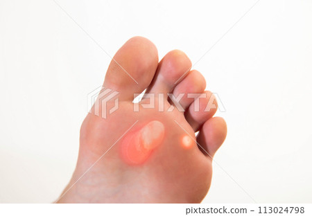 A person's foot has a large callus on its foot due to rubbing from uncomfortable shoes. Rod wart on the sole of the foot, close-up A person's foot has a large callus on its foot due to rubbing from uncomfortable shoes. Rod wart on the sole of the foot, close-up 113024798