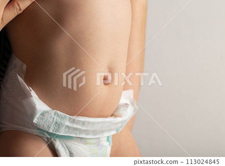 Baby belly with bulging navel on a gray background. Umbilical hernia in newborns, dilated umbilical ring, medical. Copy space for text Baby belly with bulging navel on a gray background. Umbilical hernia in newborns, dilated umbilical ring, medical. Copy space for text 113024845