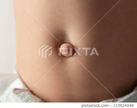 Umbilical hernia in a newborn baby on the stomach. Treatment of umbilical hernias in children without surgery, medical. Close-up Umbilical hernia in a newborn baby on the stomach. Treatment of umbilical hernias in children without surgery, medical. Close-up 113024846
