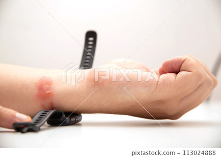 A fitness bracelet with a silicone strap taken from a person s hand. Redness, irritation and itching on the hand from the watch strap. Allergic contact dermatitis, close-up A fitness bracelet with a silicone strap taken from a person s hand. Redness, irritation and itching on the hand from the watch strap. Allergic contact dermatitis, close-up 113024888