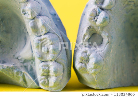 Blue plaster impression of a patient's dental jaw with crooked teeth and malocclusions on a yellow background. Manufacturing of bridges, crowns of various types, macro, arrangement of teeth Blue plaster impression of a patient's dental jaw with crooked teeth and malocclusions on a yellow background. Manufacturing of bridges, crowns of various types, macro, arrangement of teeth 113024900