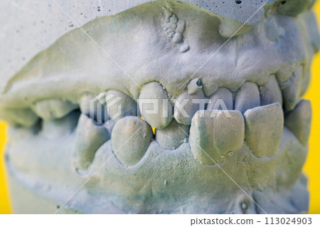 Blue plaster impression of the dental jaw of a patient with crooked teeth and malocclusions. Manufacturing of dentures and crowns based on orthodontic impressions, close-up Blue plaster impression of the dental jaw of a patient with crooked teeth and malocclusions. Manufacturing of dentures and crowns based on orthodontic impressions, close-up 113024903
