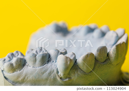 Blue plaster model of an impression of a patient's jaw at an orthodontist dentist on a yellow background. Manufacturing of dentures and crowns for dental prosthetics in orthodontics, macro. Copy space Blue plaster model of an impression of a patient's jaw at an orthodontist dentist on a yellow background. Manufacturing of dentures and crowns for dental prosthetics in orthodontics, macro. Copy space 113024904