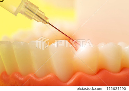 Injection of an anesthetic drug into the gum of a diseased tooth for treatment and surgery. Dental anesthesia in dentistry, freezing, macro. Copy space for text 113025290