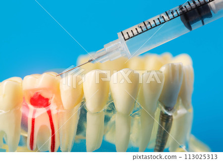 Injection of an anesthetic drug into the gum of a diseased tooth for treatment and surgery. Dental anesthesia in dentistry, freezing, macro. Copy space for text 113025313
