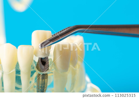 A dental crown made of metal ceramics in tweezers against the background of a medical model of the dental jaw. The concept of making dental crown molds for a patient s tooth from different alloys. 113025315