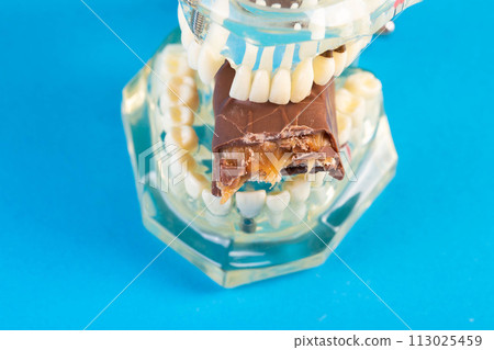 A bitten piece of chocolate in a dental jaw mockup on a blue background. The concept of the effect of sugar and leftover food on teeth and tooth enamel. Tooth destruction by bacteria, caries, 113025459