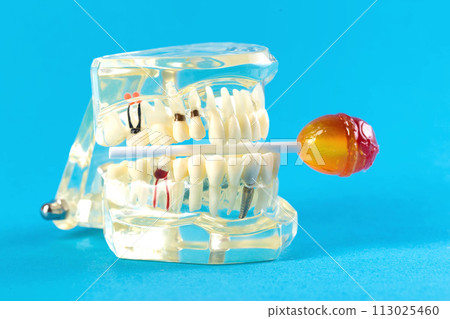 Candy on a stick in a tooth jaw mockup on a blue background. Concept of the effect of candies and sweets on the oral cavity and tooth enamel. Tooth destruction by sweet bacteria. Pulpitis and caries, 113025460