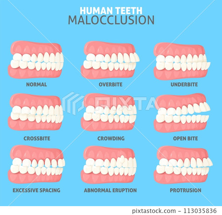 Malocclusion types side view dentist medical poster 113035836