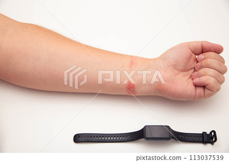Redness and allergies on a person s wrist from wearing a fitness bracelet with a silicone strap. Contact dermatitis, close-up Redness and allergies on a person s wrist from wearing a fitness bracelet with a silicone strap. Contact dermatitis, close-up 113037539
