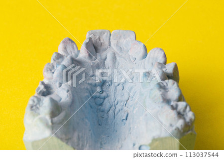 Blue plaster impression of a patient's dental jaw with crooked teeth and malocclusions on a yellow background. Manufacturing of braces to correct bite. View from above. Copy space for text Blue plaster impression of a patient's dental jaw with crooked teeth and malocclusions on a yellow background. Manufacturing of braces to correct bite. View from above. Copy space for text 113037544