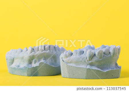 Blue plaster impression of a patient's dental jaw with crooked teeth and malocclusions on a yellow background. Manufacturing of bridges, crowns of various types, macro. Copy space for text Blue plaster impression of a patient's dental jaw with crooked teeth and malocclusions on a yellow background. Manufacturing of bridges, crowns of various types, macro. Copy space for text 113037545