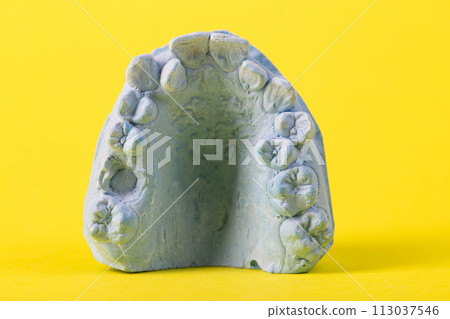Blue plaster impression of a patient's dental jaw with crooked teeth and malocclusions on a yellow background. Manufacturing of braces to correct bite. View from above. Copy space for text Blue plaster impression of a patient's dental jaw with crooked teeth and malocclusions on a yellow background. Manufacturing of braces to correct bite. View from above. Copy space for text 113037546