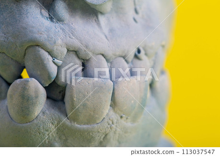 Blue plaster impression of the dental jaw of a patient with crooked teeth and malocclusions. Manufacturing of dentures and crowns based on orthodontic impressions, close-up Blue plaster impression of the dental jaw of a patient with crooked teeth and malocclusions. Manufacturing of dentures and crowns based on orthodontic impressions, close-up 113037547