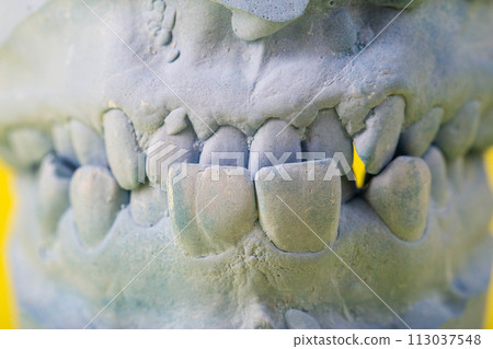 Blue plaster impression of the dental jaw of a patient with crooked teeth and malocclusions. Manufacturing of dentures and crowns based on orthodontic impressions, close-up Blue plaster impression of the dental jaw of a patient with crooked teeth and malocclusions. Manufacturing of dentures and crowns based on orthodontic impressions, close-up 113037548