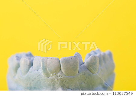 Blue plaster model of an impression of a patient's jaw at an orthodontist dentist on a yellow background. Manufacturing of dentures and crowns for dental prosthetics in orthodontics, macro. Copy space 113037549