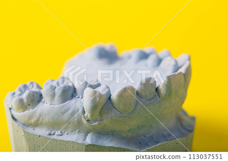 Blue plaster model of an impression of a patient's jaw at an orthodontist dentist on a yellow background. Manufacturing of dentures and crowns for dental prosthetics in orthodontics, macro. Copy space Blue plaster model of an impression of a patient's jaw at an orthodontist dentist on a yellow background. Manufacturing of dentures and crowns for dental prosthetics in orthodontics, macro. Copy space 113037551