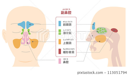 從正面和側面(矢狀面)觀察鼻竇解剖結構的插圖 從正面和側面(矢狀面)觀察鼻竇解剖結構的插圖 113051794