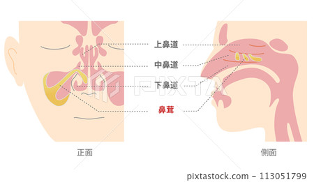 Illustration of polyps in the sinuses from the front and side Illustration of polyps in the sinuses from the front and side 113051799
