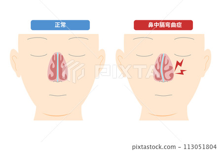 Illustration of midnasal curvature caused by deformation of the nasal midsection 113051804