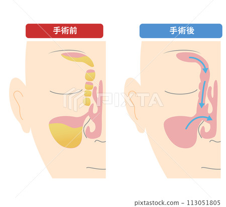 如何進行鼻內視鏡手術(ESS)及術前對照圖 如何進行鼻內視鏡手術(ESS)及術前對照圖 113051805