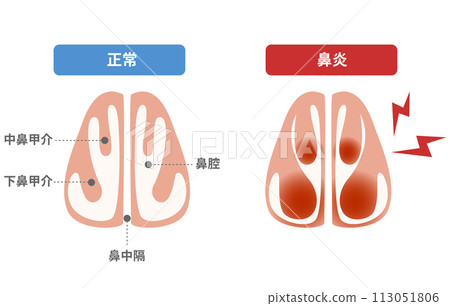 鼻炎時下鼻甲血管擴張，鼻塞 113051806