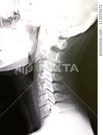 X-ray of the neck (cervical vertebrae) X-ray of the neck (cervical vertebrae) 113054872