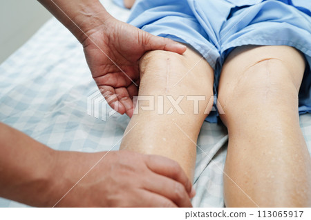 Doctor checking Asian elderly woman patient with scar knee replacement surgery in hospital. 113065917