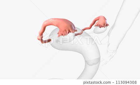 The fallopian tubes are bilateral conduits between the ovaries and the uterus in the female pelvis 113094308
