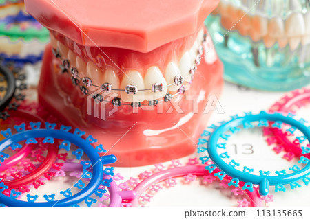 Orthodontic ligatures rings and ties, elastic rubber bands on orthodontic braces, model for dentist studying about dentistry. 113135665