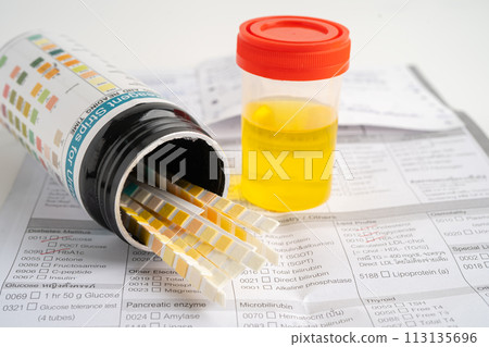 Urinalysis, urine cup with reagent strip pH paper test and comparison chart in laboratory. 113135696