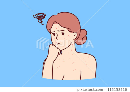 Woman with allergic rash on face and body looks sadly at screen, needing help of dermatologist 113158316