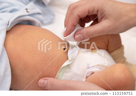 Cleaning newborn baby umbilical cord with a cotton swab, treat the navel to a newborn baby. Closeup. First week of life. 113159751