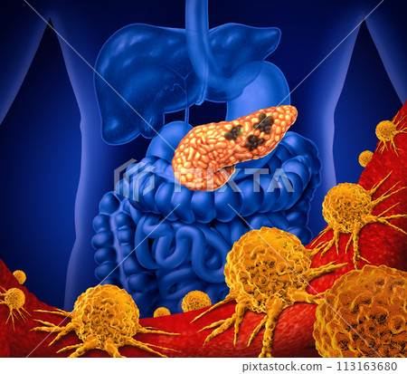 Cancer Of The Pancreas 113163680