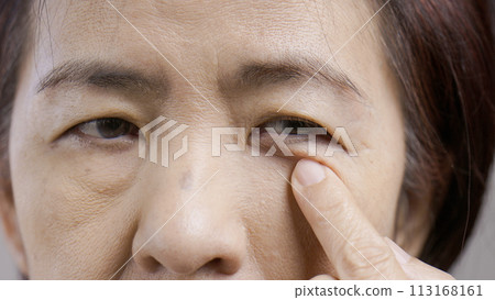 Senior asian woman worry about eye bags and dark spot. 113168161