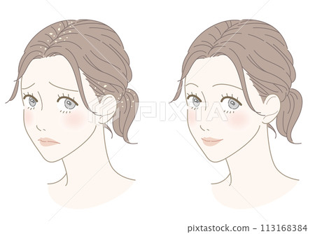 Dandruff improvement female illustration 113168384