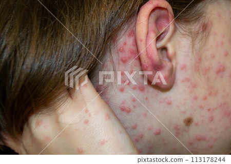 Varicella virus or Chickenpox bubble rash on child Varicella virus or Chickenpox bubble rash on child 113178244
