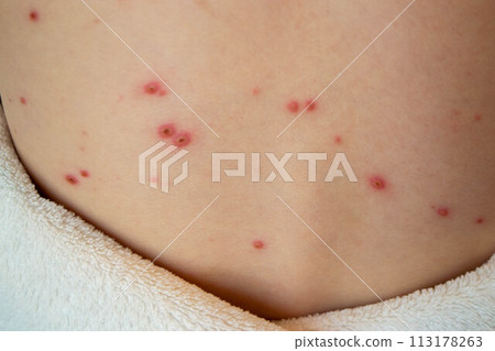 Natural vaccination. Contagious disease. Natural vaccination. Contagious disease. 113178263