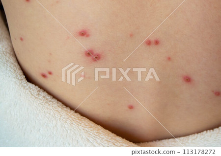 Natural vaccination. Contagious disease. 113178272