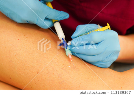 Removal of varicose veins on the legs. Doctor doing sclerotherapy Removal of varicose veins on the legs. Doctor doing sclerotherapy 113189367