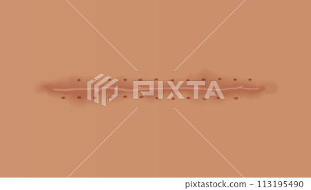 Healing wounds, skin scar, stitched gash and cut. Realistic surgical suture, stitched wounds. Healing stage on human skin background. Vector illustration 113195490