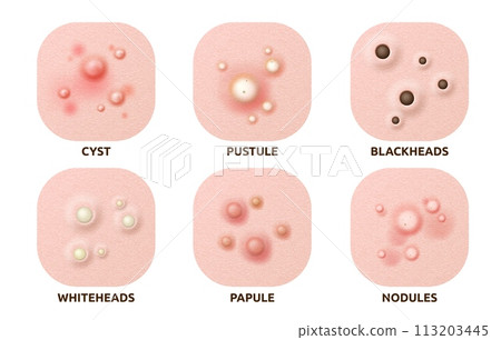 Body skin acne type blackheads, whiteheads, papule, pustule, cyst and nodules. Realistic 3d vector skin disease caused by excess oil production, bacteria, and inflammation, hormonal changes or sweat Body skin acne type blackheads, whiteheads, papule, pustule, cyst and nodules. Realistic 3d vector skin disease caused by excess oil production, bacteria, and inflammation, hormonal changes or sweat 113203445