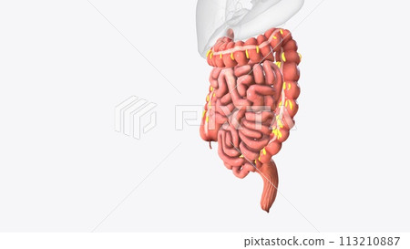Epiploic appendages are normal outpouchings of peritoneal fat on the anti-mesenteric surface of the colon Epiploic appendages are normal outpouchings of peritoneal fat on the anti-mesenteric surface of the colon 113210887