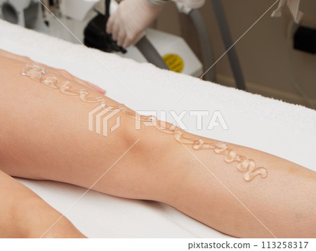 removing hair with laser treatment removing hair with laser treatment 113258317