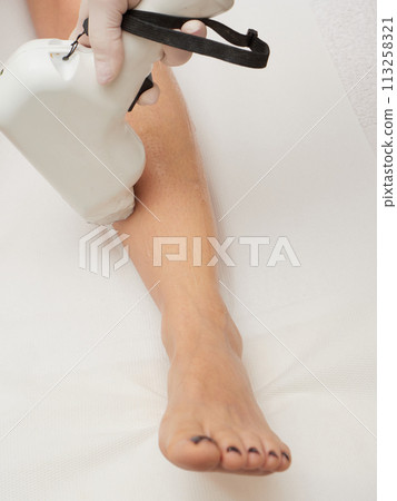 removing hair with laser treatment removing hair with laser treatment 113258321