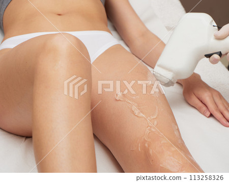 removing hair with laser treatment 113258326