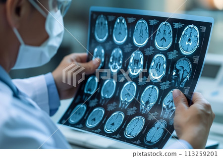 Close up view of a doctors hand holding an X-ray film of the brain 113259201