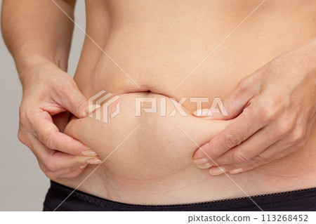 Hands on belly pressed skin to show sagging skin after diet and stretch marks after pregnancy Hands on belly pressed skin to show sagging skin after diet and stretch marks after pregnancy 113268452