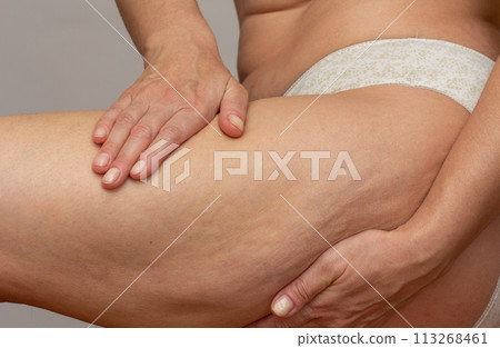 Cropped woman body with hands on leg pressing skin to show cellulite 113268461